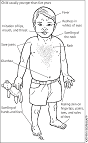 Kawasaki disease signs and