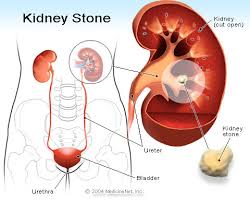 What causes kidney stones?