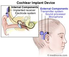Cochlear Implants