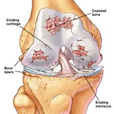 osteoarthritisknee1
