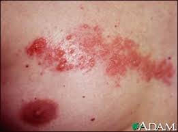 shingles virus