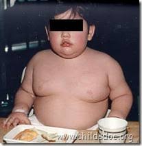 Prader-Willi syndrome is a