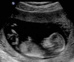 BabyUltrasound Ultra sound pictures.