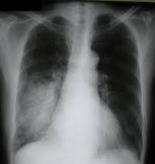 Pneumona