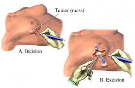 Lumpectomy
