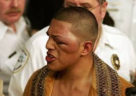 losing to Shane Mosley