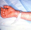 rocky mountain spotted fever