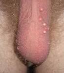 File:Scrotal epidermoid cysts.jpg - Wikipedia, the free encyclopedia