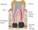 Nonsurgical Retreatment of Endodontic therapy, Endodontic ...