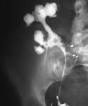 <b>Renal</b> transplant <b>tuberculosis</b>.