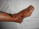<b>granulomatosi di Wegener</b>.