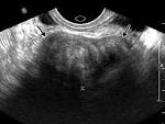 <b>neoplasm</b> such as <b>ovarian</b>