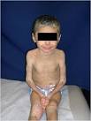 <b>ichthyosiform erythroderma</b>