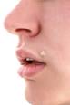 Discovery Health "How Filiform Warts Work"
