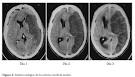 El <b>edema</b> cerebral causa un