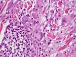 Two cases of annular elastolytic giant cell granuloma: Different ...
