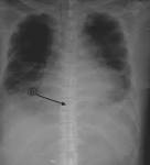 necrotizing <b>mediastinitis</b>.