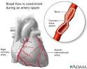 Coronary artery <b>spasm</b>: