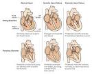 Types of Heart Failure - Heart Failure - cardiovascular-disease ...
