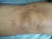 <b>Mycosis fungoides</b>: Definition from Answers.