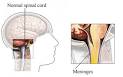 <b>Viral meningitis</b>; Aseptic