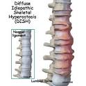 <b>Diffuse Idiopathic Skeletal</b>