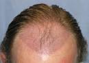 Recipient Sites in Hair Transplant Surgery | Bernstein Medical ...