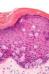 File:<b>Extramammary Paget disease</b> - very high mag.jpg - Wikimedia