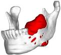 <b>Jaw Tumor</b> removed by