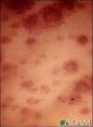 <b>Acute monocytic leukemia</b>
