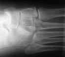 Lisfranc's Fracture / TarsoMetatarsal Injuries - Wheeless ...