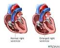 Tricuspid Regurgitation: MedlinePlus Medical Encyclopedia Image