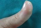 <b>CREST</b> (calcinosis, Raynaud