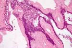File:Benign pancreatic <b>mucinous cystic neoplasm</b> - high mag.jpg