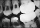 <b>Dentin Dysplasia</b> Type II