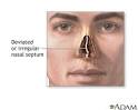 Septal deviation -