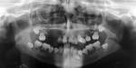 <b>dentin dysplasia</b> type I.
