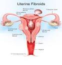 Information about Uterine Fibroids Symptoms, Causes, and ...
