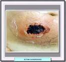 El <b>ectima</b> gangrenoso se