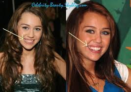New Teeth for Ciley Myrus!!! - Plastic Surgery and Celebrities - 2271453445_small_1