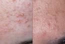  What is the Best Acne Skin Care System? 3 Tips to Find It