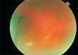 <b>Pars planitis</b> is inflammation