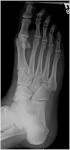 File:<b>Radiografía</b> plantar.jpg