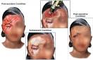 Dermabrasion | Lifescript.