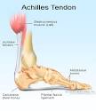 Achilles Tendon Rupture