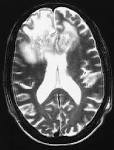 <b>Meningoencephalitis</b> and to