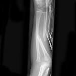 <b>Monteggia fracture</b>-dislocation