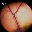 Progressive Retinal Atrophy