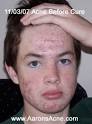  Natural Remedies For Acne