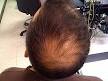Androgenic alopecia - Wikipedia, the free encyclopedia